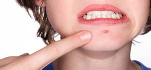 fish oil acne